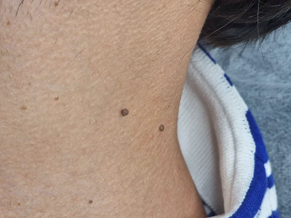 Skin blemish treatment at WOB Beauty