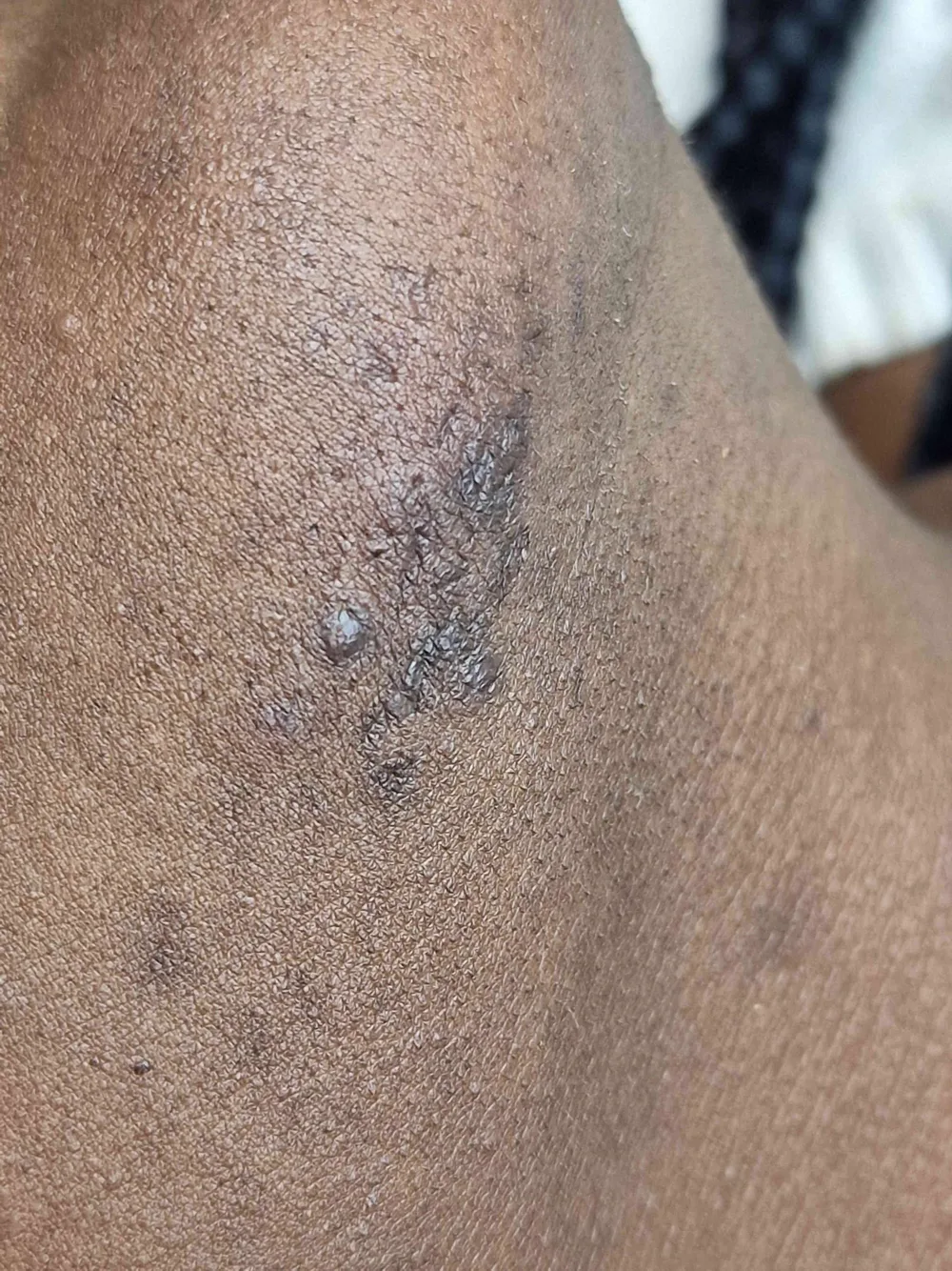 Electrolysis hair removal treatment close-up