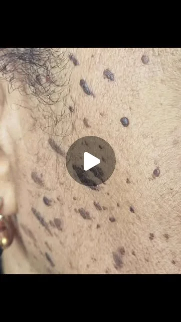 Close view of a client's cheek with DPN and treatment mapping marks