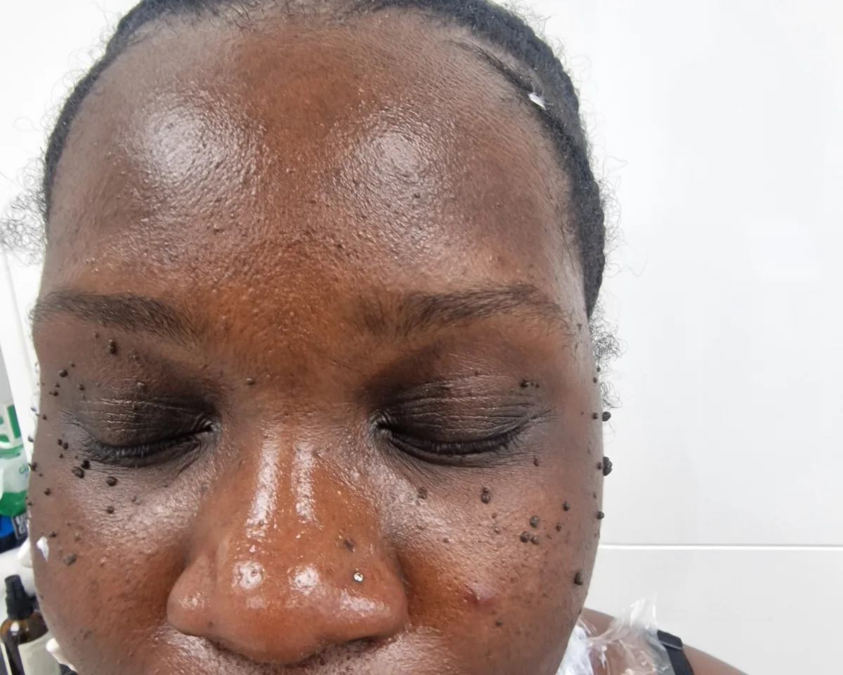 Dense DPN across the forehead and cheeks before treatment, client one