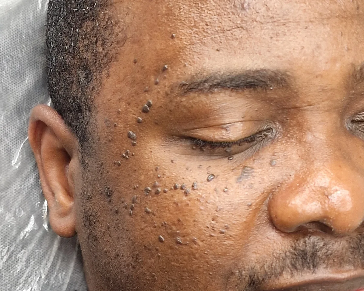 DPN papules on the temple and cheek before treatment, client two